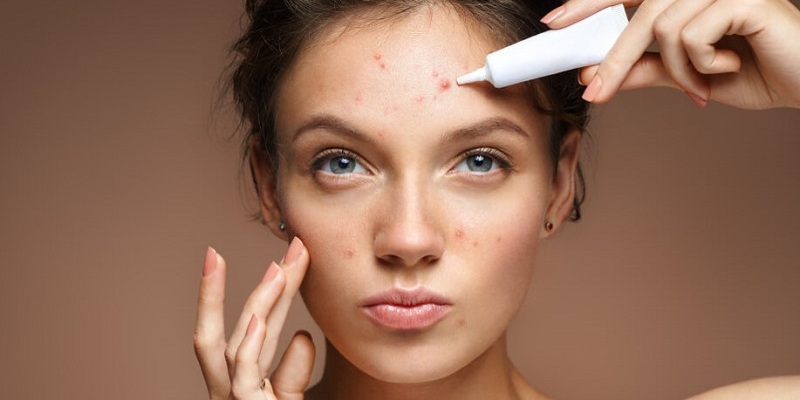 How To Get Rid Of Acne Naturally